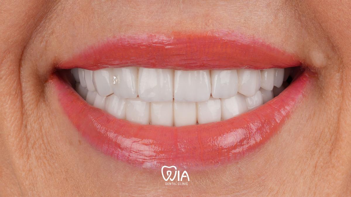 After — Hollywood Smile