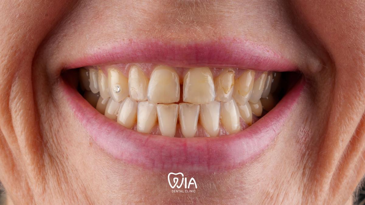 Before — Hollywood Smile