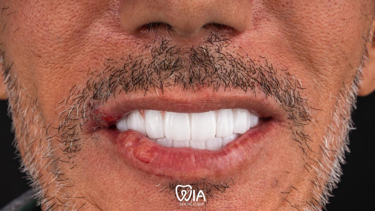 After — Dental Crowns