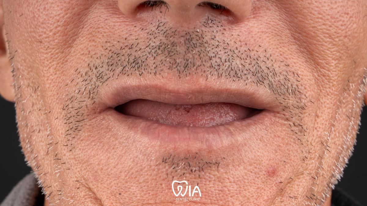 Before — Dental Crowns