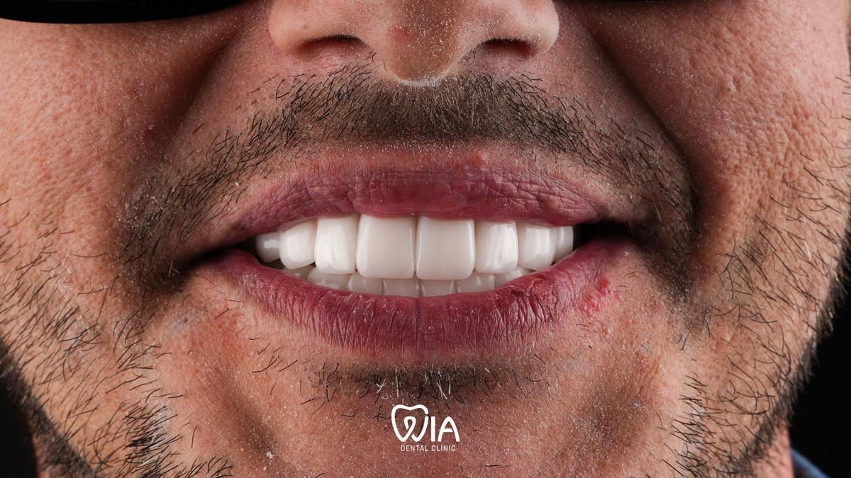 After — Complex Treatment